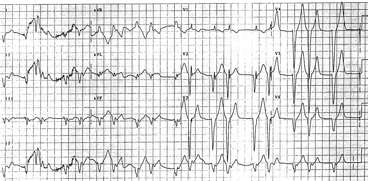 74 year old man with angina and history of anterior infarction 6 years previously. 