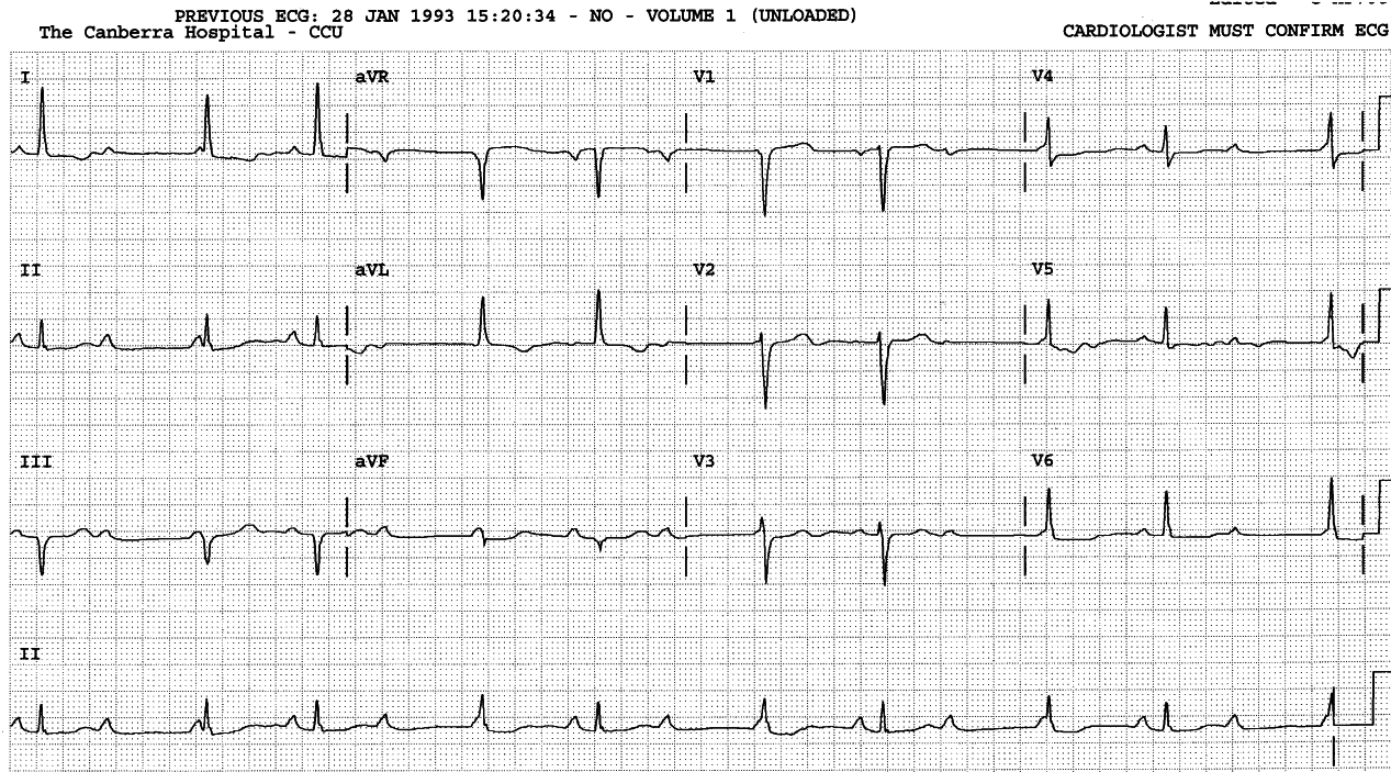 Variable AV block in the top strips eventually succumbed to complete AVB and junctional escape rhythm.