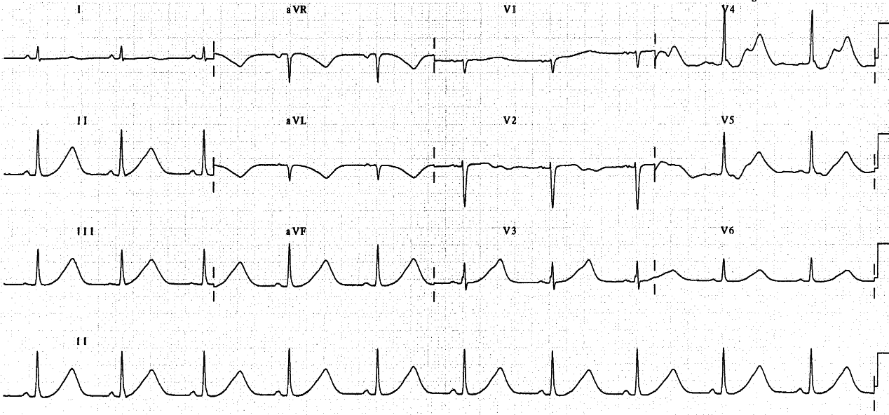 Pre-extubation trace of 53 year old alcoholic lady in ICU with pneumonia and shock