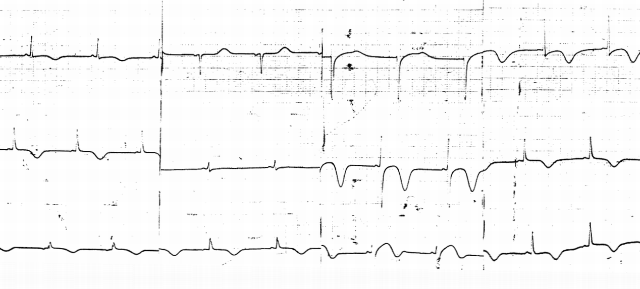 Unconscious 33 year old lady, hypotensive 65 mmHg systolic, with severe hypertensive changes in the optic fundi.