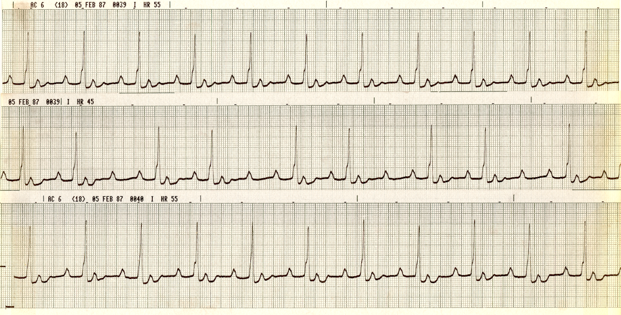 77 year old woman with the following Cardiologist's report: "Sinus bradycardia. Prominent U waves." 