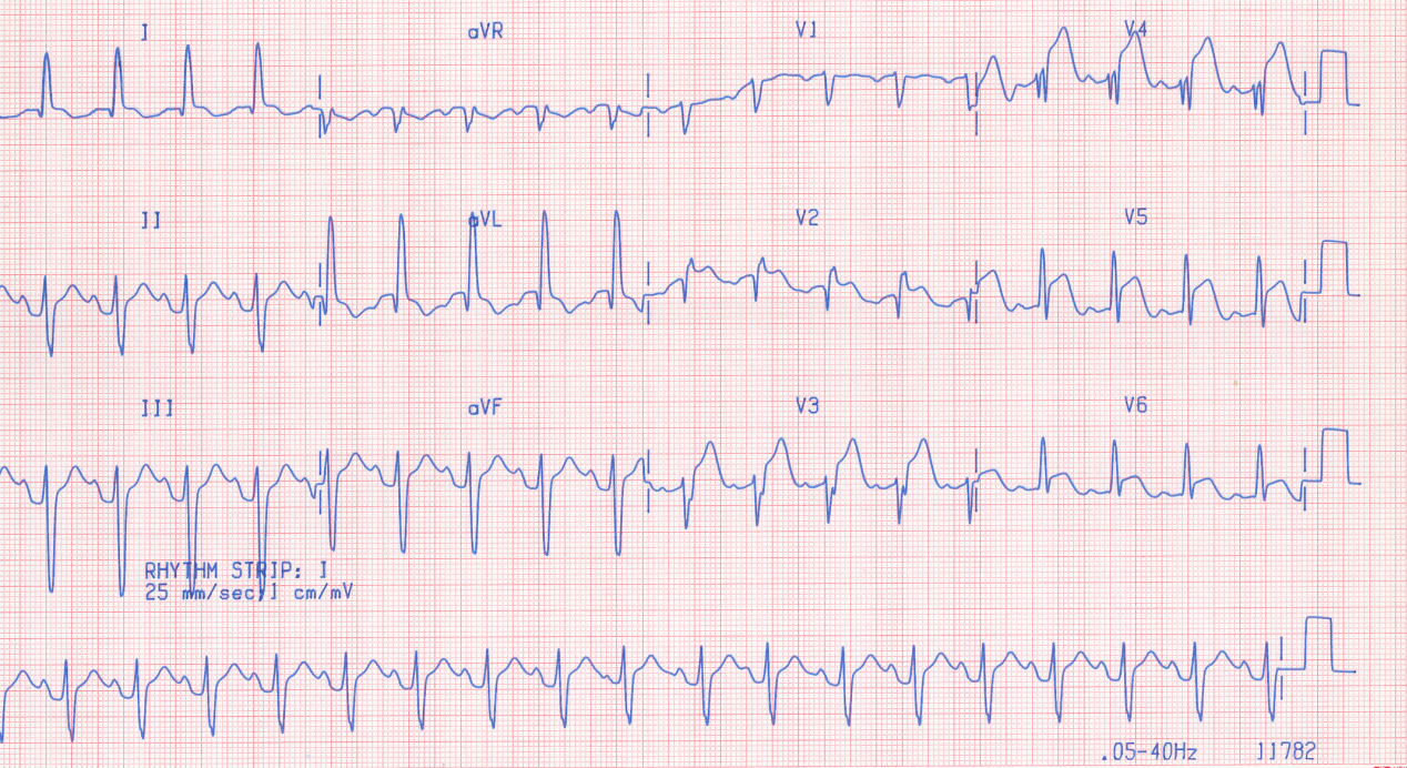 68 year old woman in coma