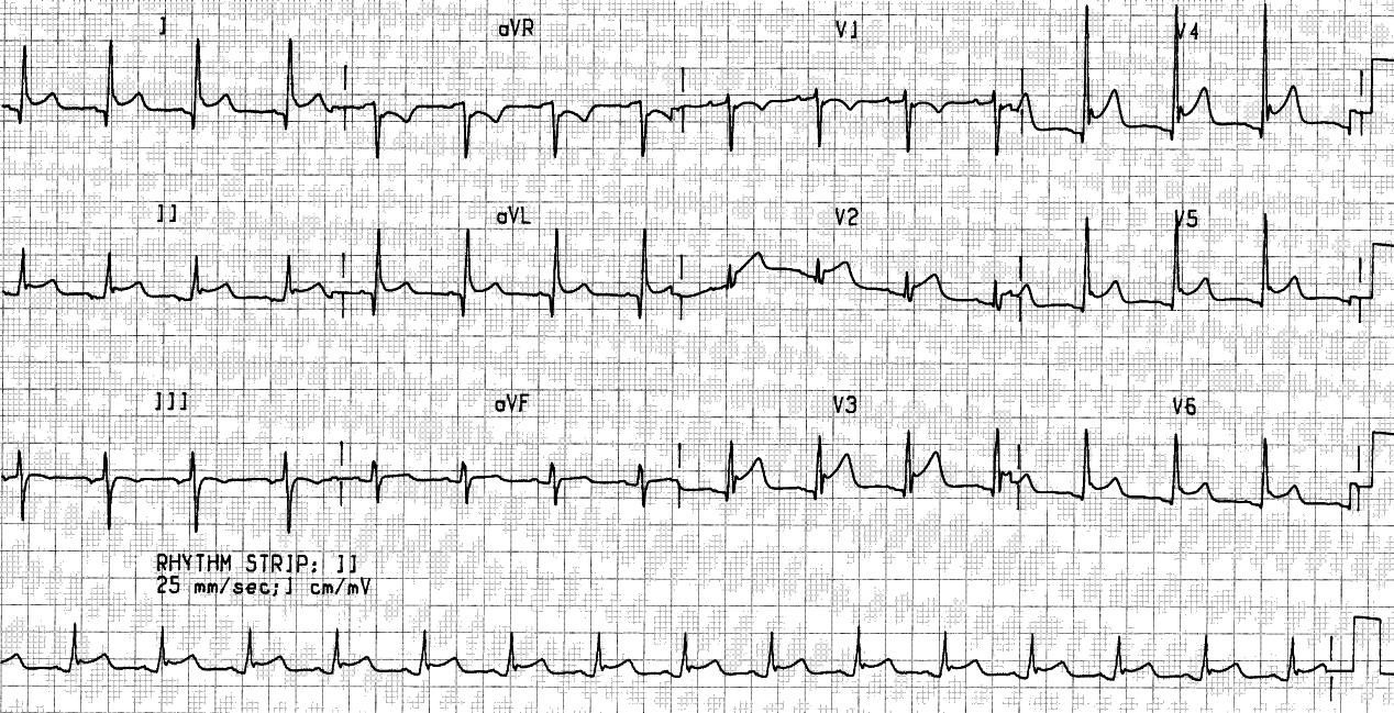 50 year old lady in ICU with multitrauma