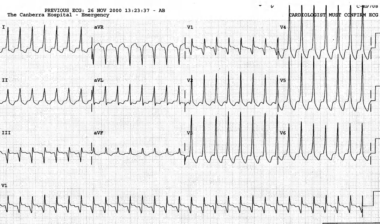 81 year old man with weakness and dizziness for three days, unaware of his heart rate. After failed adenosine and verapamil trial, amiodarone 150 IV restored sinus rhythm. 