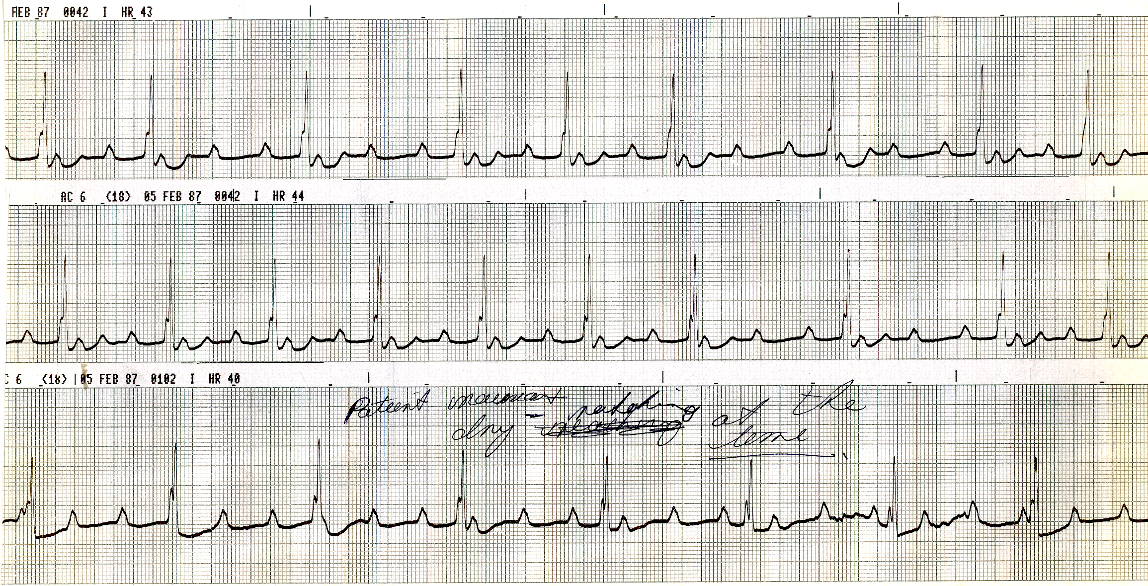 60 year old man with abdominal pain, dry retching and nausea due to an exacerbation of idiopathic cardiomyopathy. Explain the middle strip. 