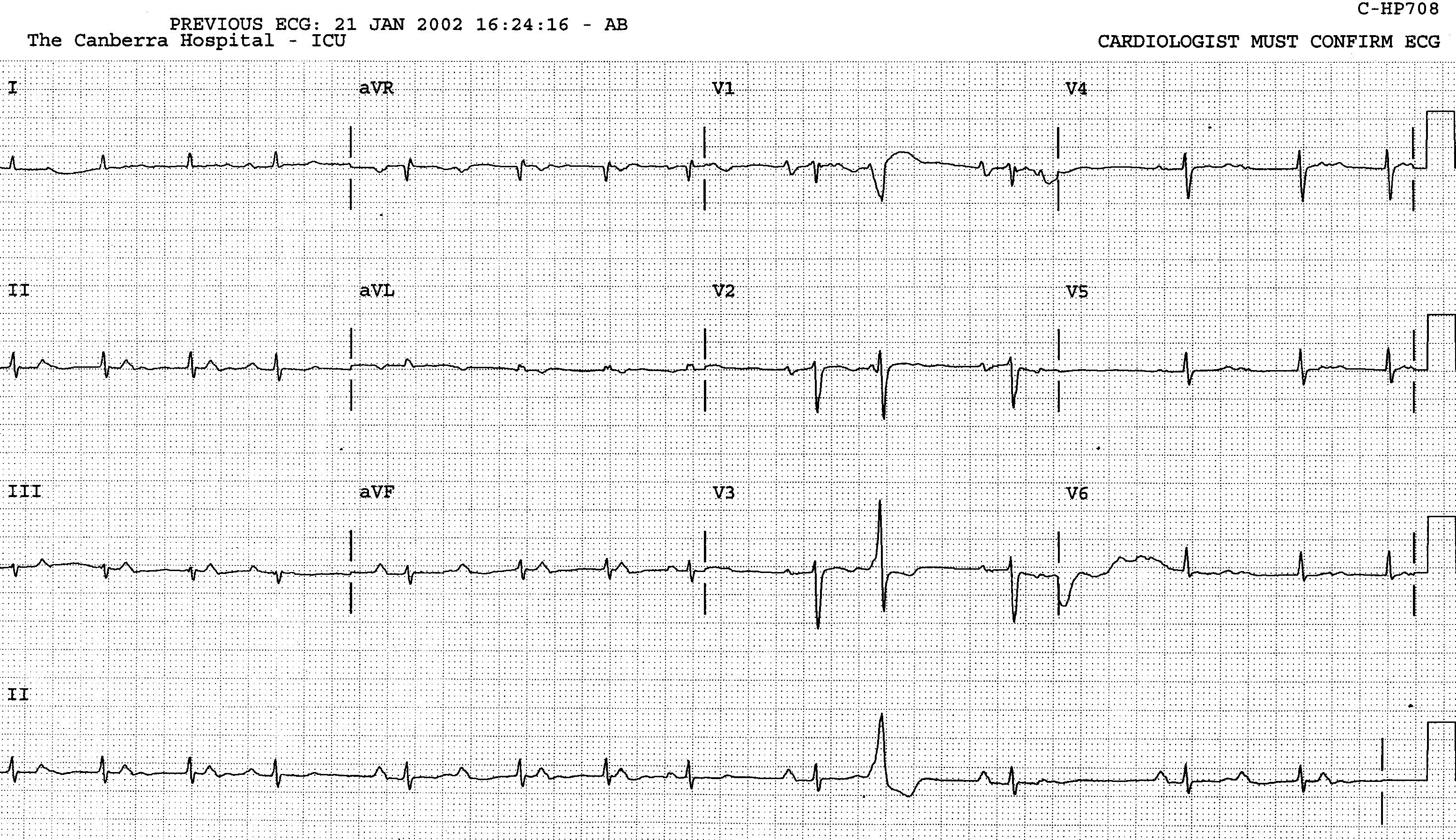 74 year old lady post-lobectomy for carcinoma. 