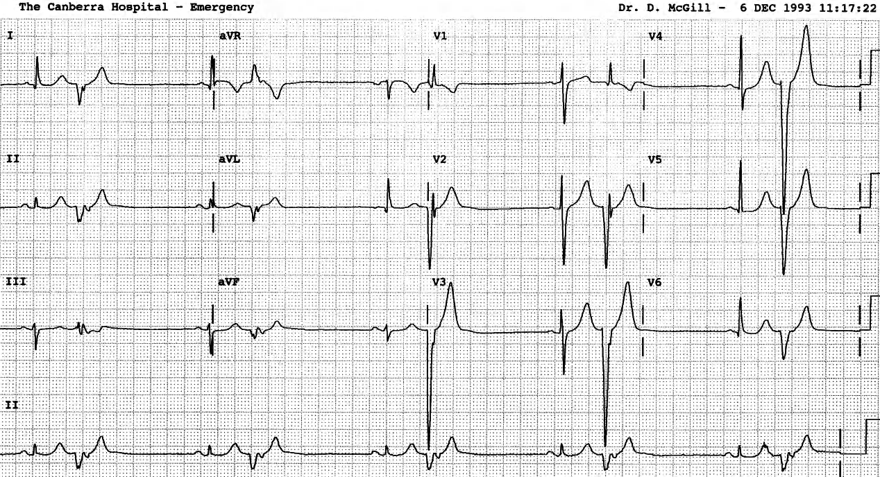 Bigeminal VEBs same as during the VT above. Sinus rate would have been faster without the retrograde conduction of the VEBs. 