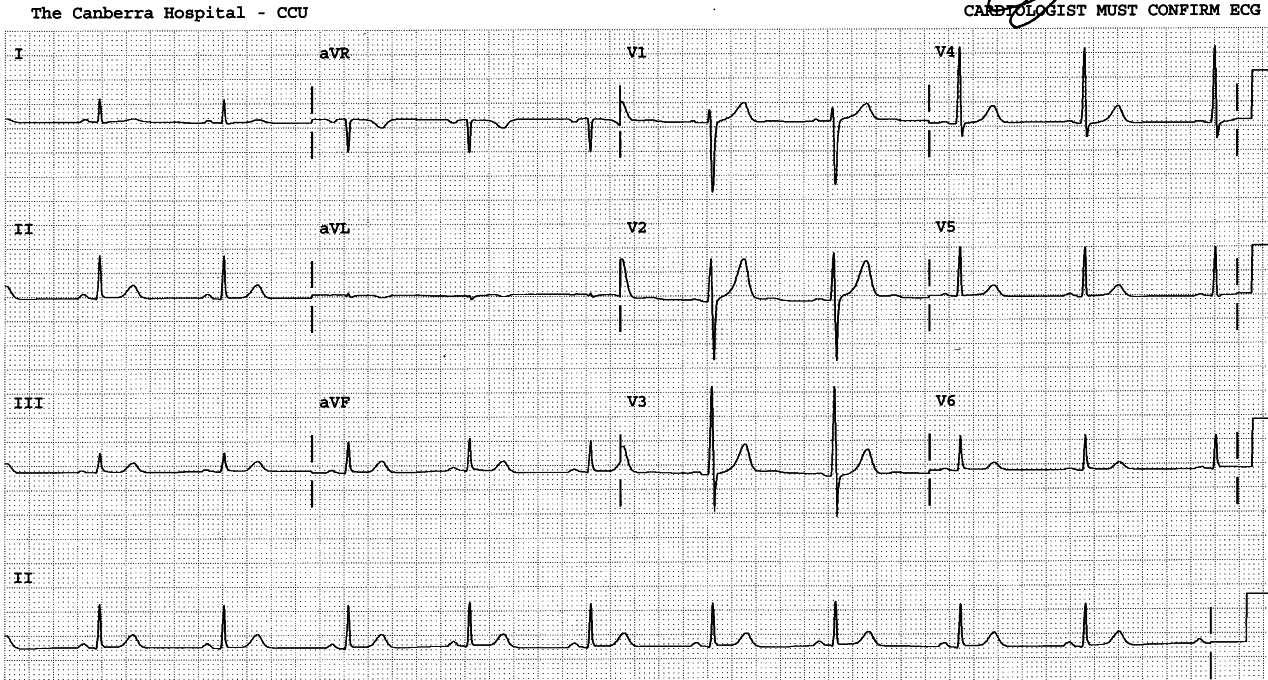 51 year old man with chest pain and normal-looking ECG.