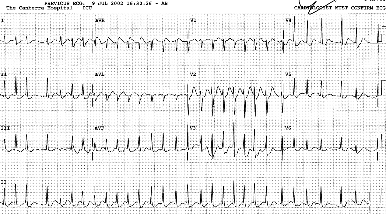 Preceding AF with rapid response. Lead 2, again, (as in Case 65) performs badly for RBBB aberrancy.