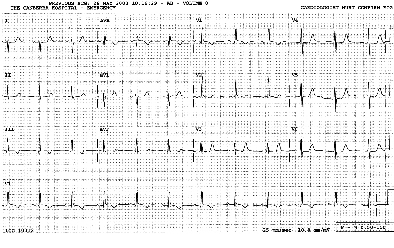 PolycythÃ¦mic 30 year old lady with history of Mustard procedure and a known VSD