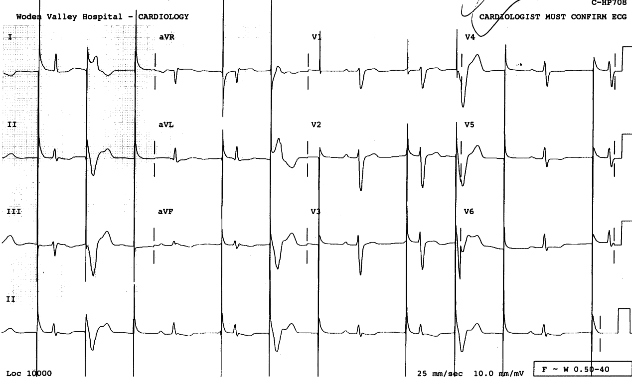 Allorhythmic recording in a 60 year old lady with permanent
pacemaker.