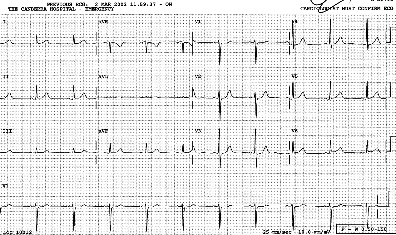 The ST segment in V1 is 1mm horizontally depressed, in V3 slow to rise; in V2 there is a sharp angulation at the ST/T junction.