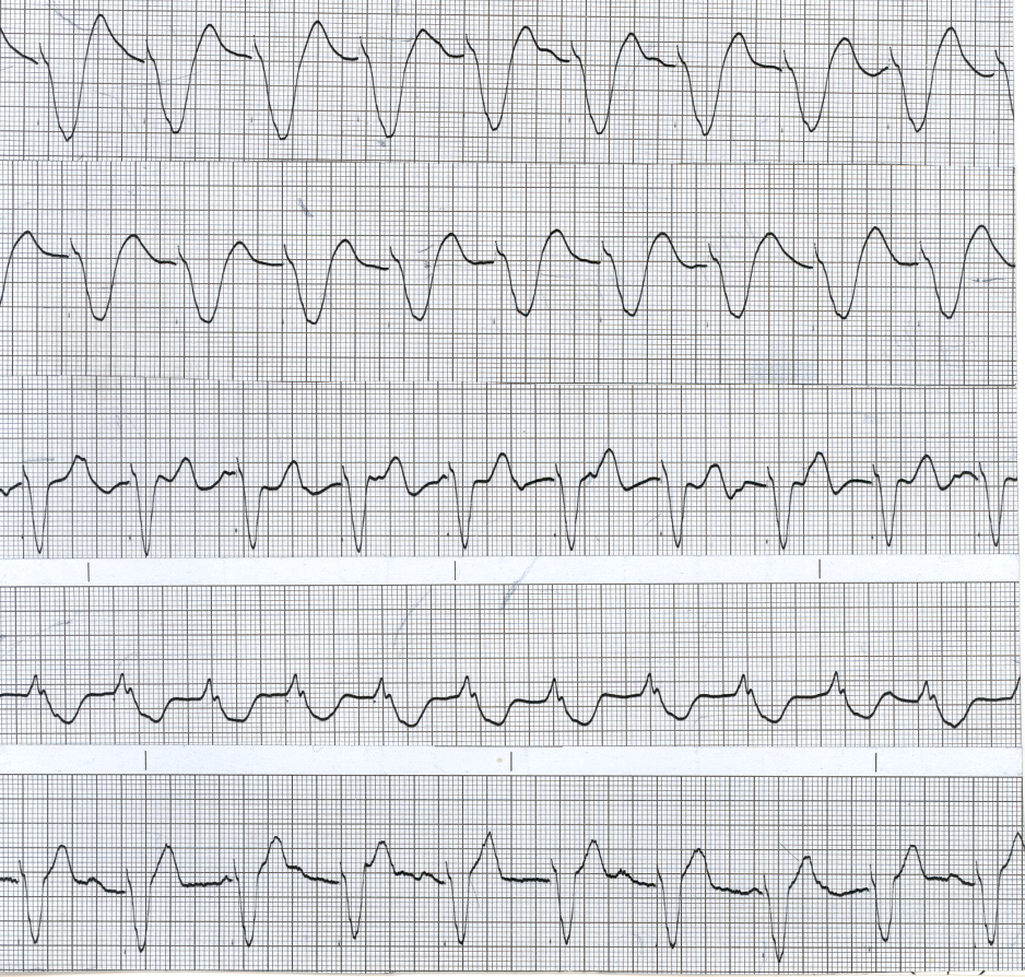 Code Blue in a 66
year old woman with acute-on-chronic renal failure.