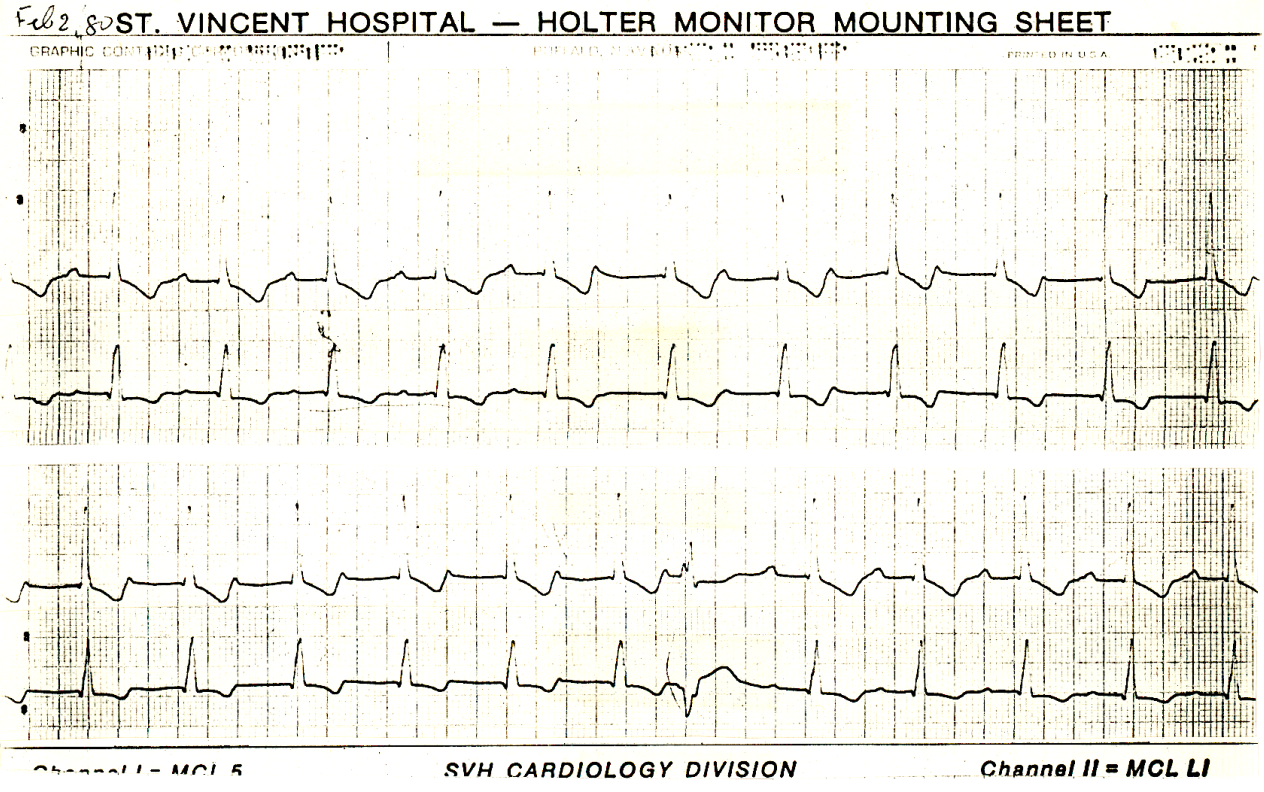 73 year old woman on Holter monitor following an episode of     SVT. 