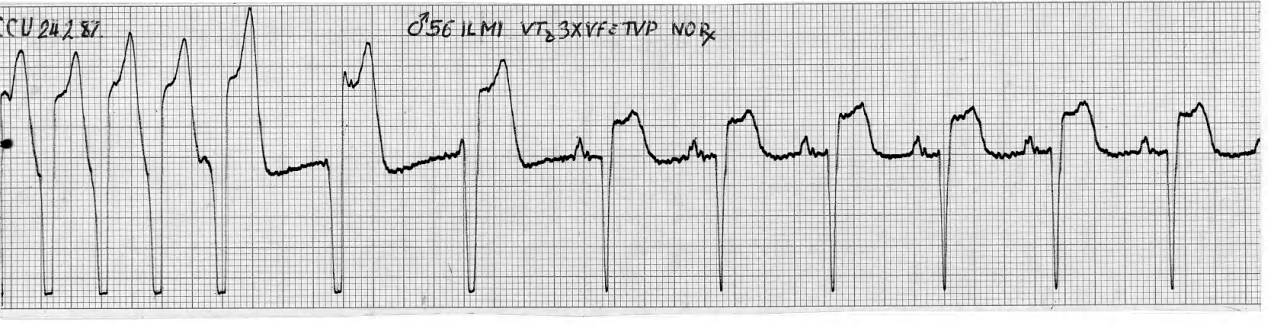 In some cases AIVR may be a VT in disguise, with 2:1 exit block. 