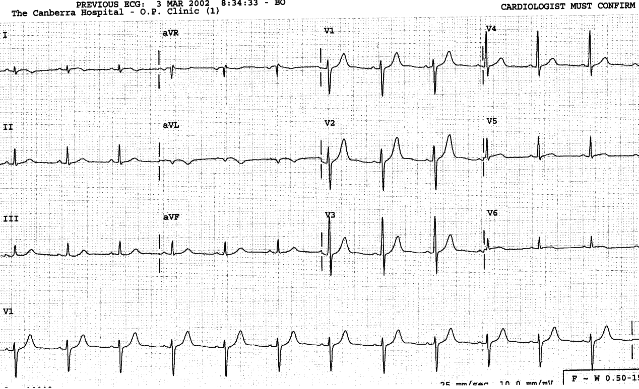 Obvious anterolateral infarction.