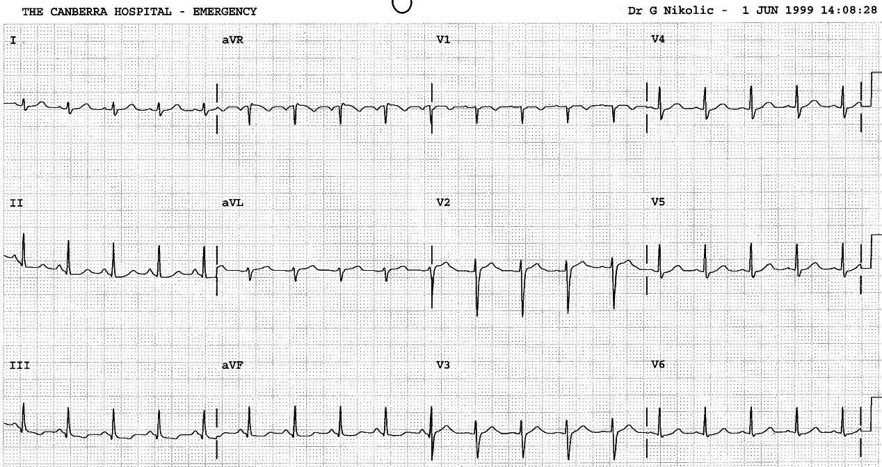 Suddenly breathless 21 year old lady. The CXR is clear.