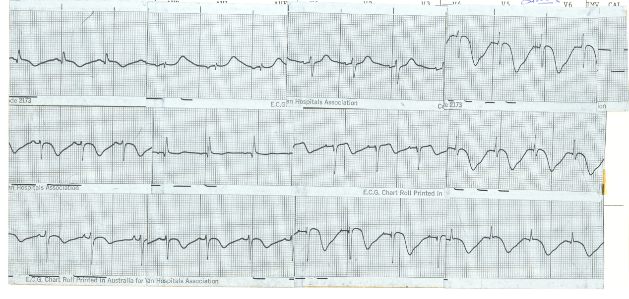 54 year old lady who collapsed at home and was admitted, very drowsy but rousable, to CCU