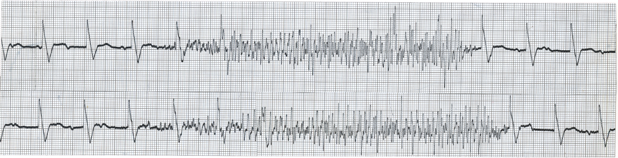 Outpatient recording on a 70 year old man with exertional
syncope. He fainted when pulling his interlocked hands apart and was
discharged home without any further investigation or
treatment.