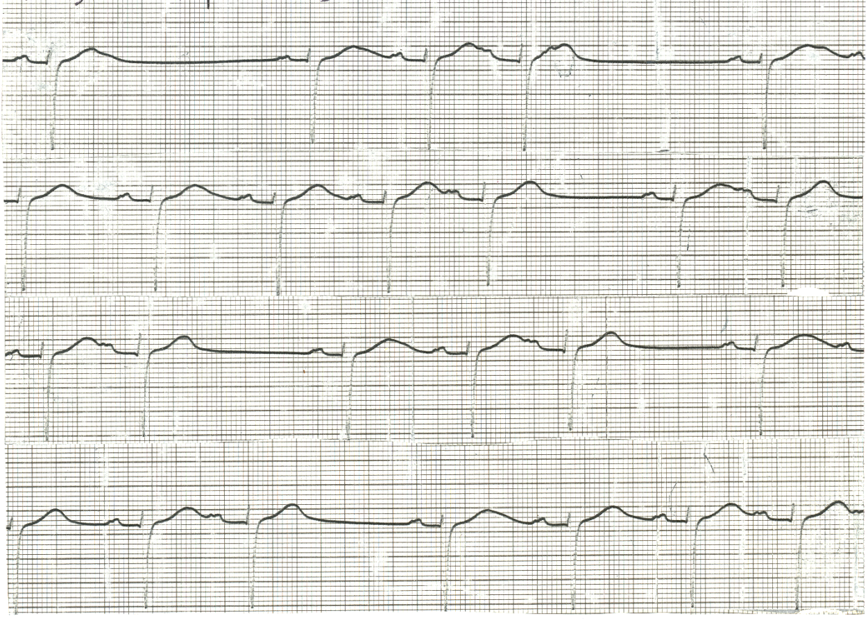 One block blocked by another in a 70 year old man on digoxin and     quinidine. 