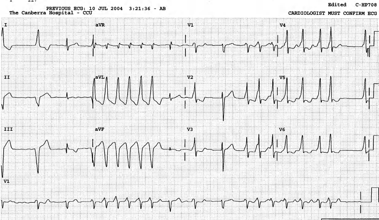 53 year old man with chronic atrial fibrillation, on sotalol therapy prior to planned cardioversion. 