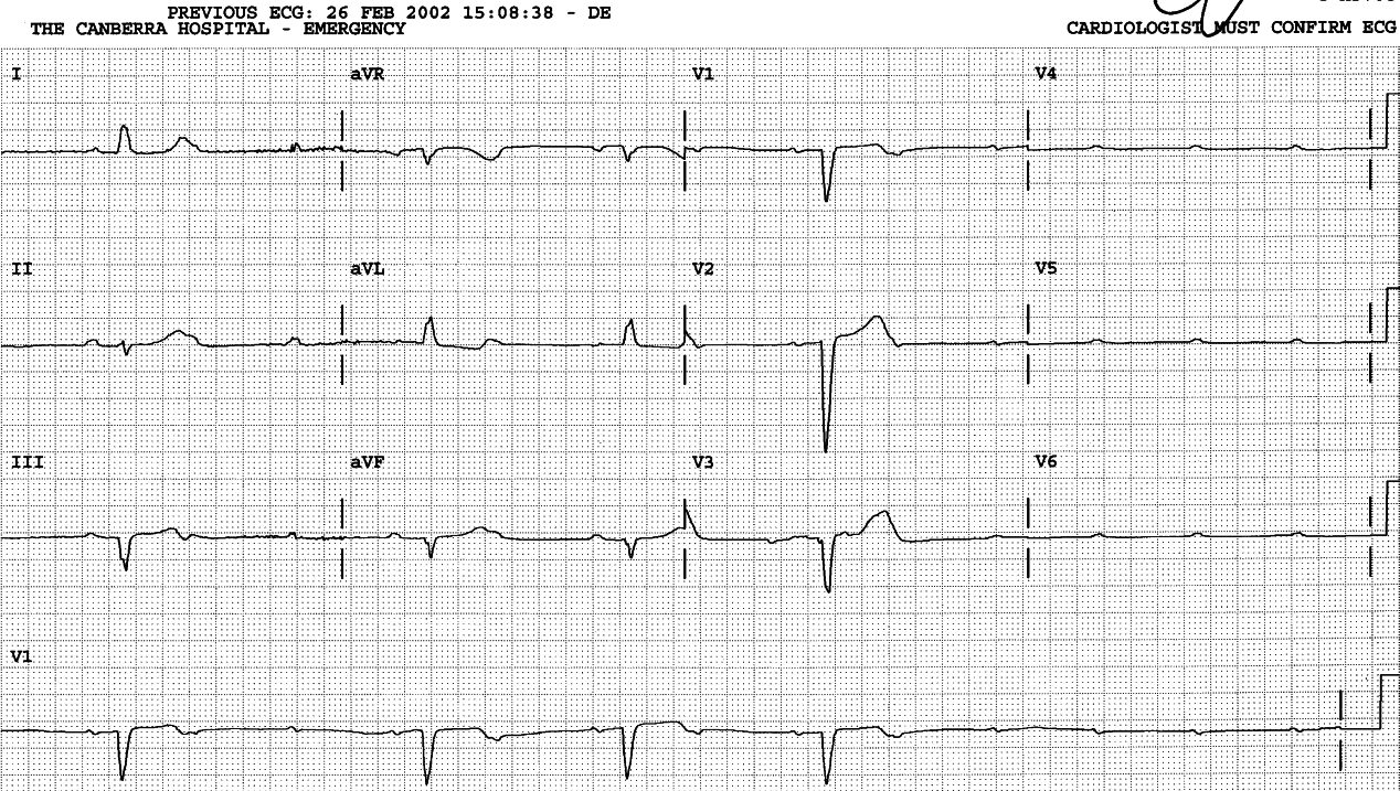 76 year old lady with several daysâ history of chest pains and grayouts. She was asymptomatic during the recording shown below. 