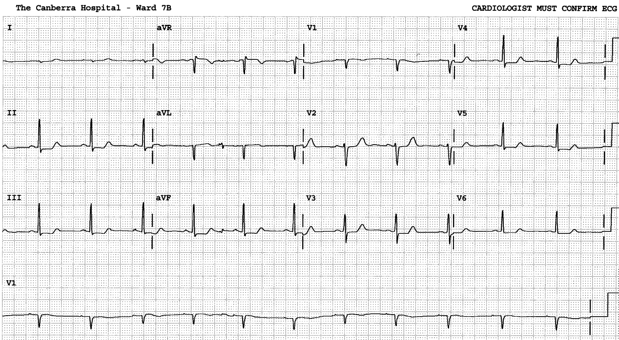 62 year old lady with angina pectoris.