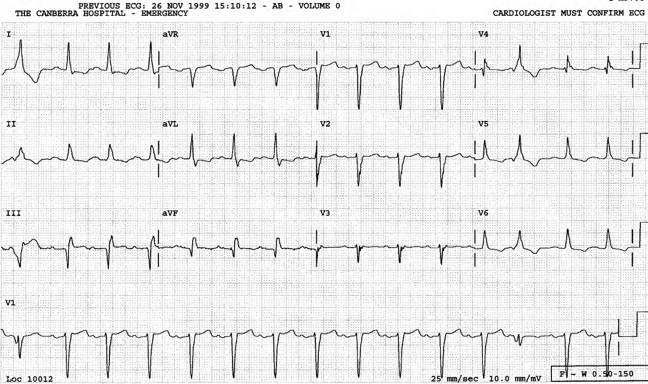 The VEBs are like the preceding VT. The trace shows LAA, 1o AVB, poor R wave progression, inferior Q waves and ST/T changes. 