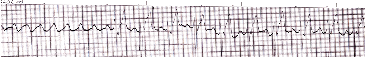 Cardiogenic shock in a 46 year old man with new LBBB. 