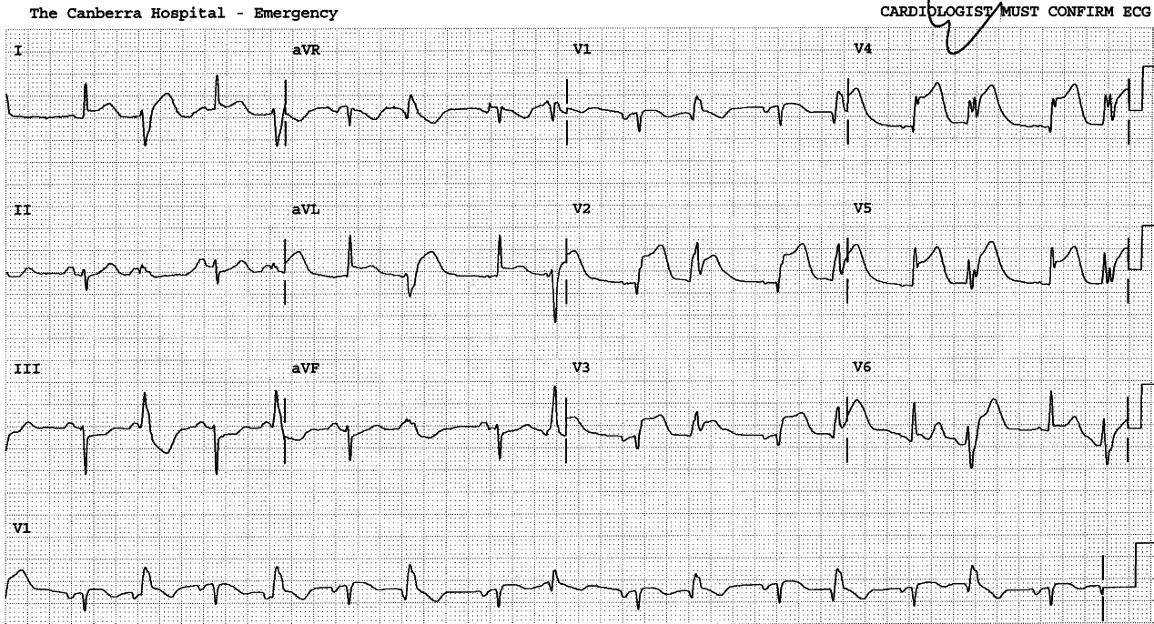 67 year old man with chest pain.