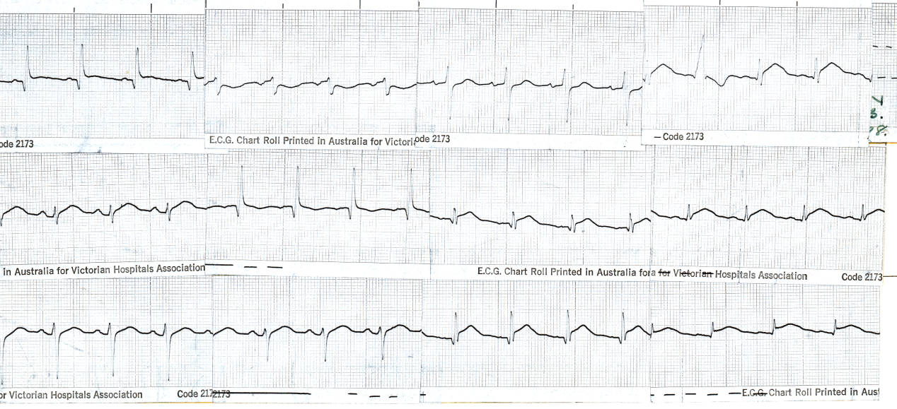 Admission to CCU based on this ECG. She was, however, unaccountably drowsy.