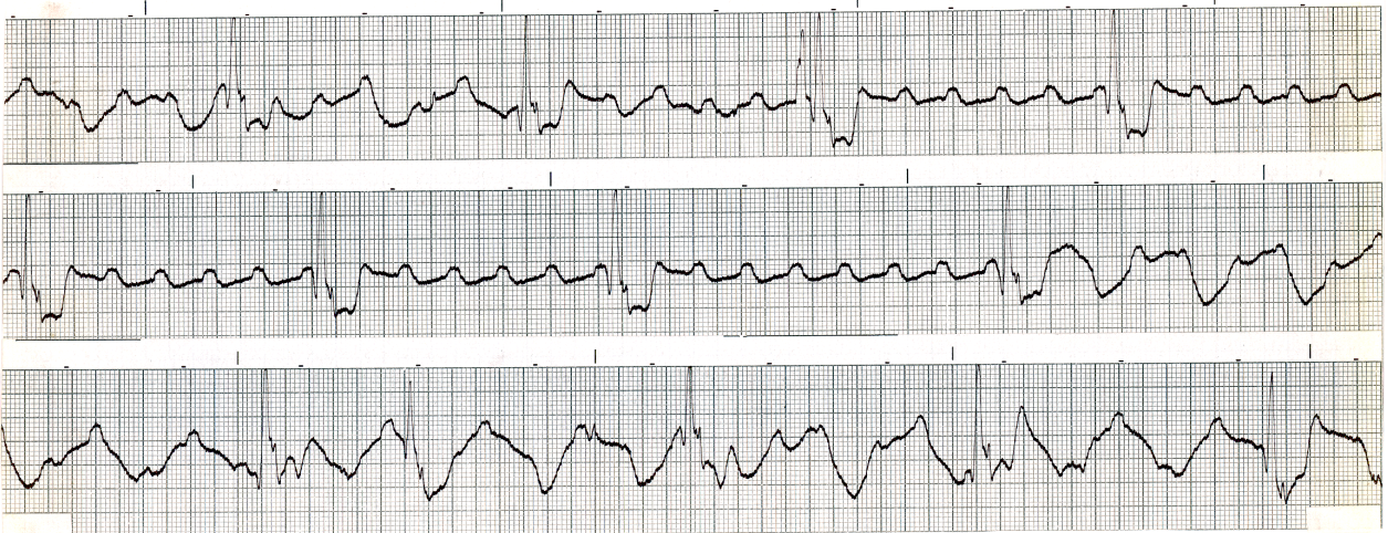 Spontaneous resumption of 2:1 conduction. 