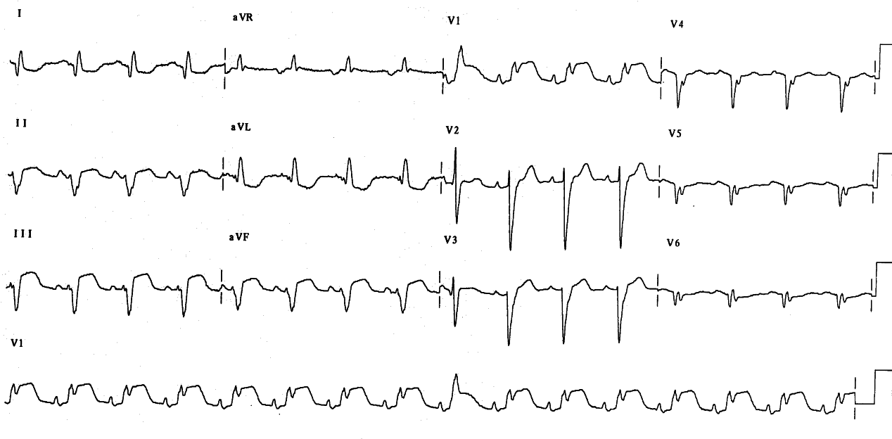 60 year old man with chest pain.