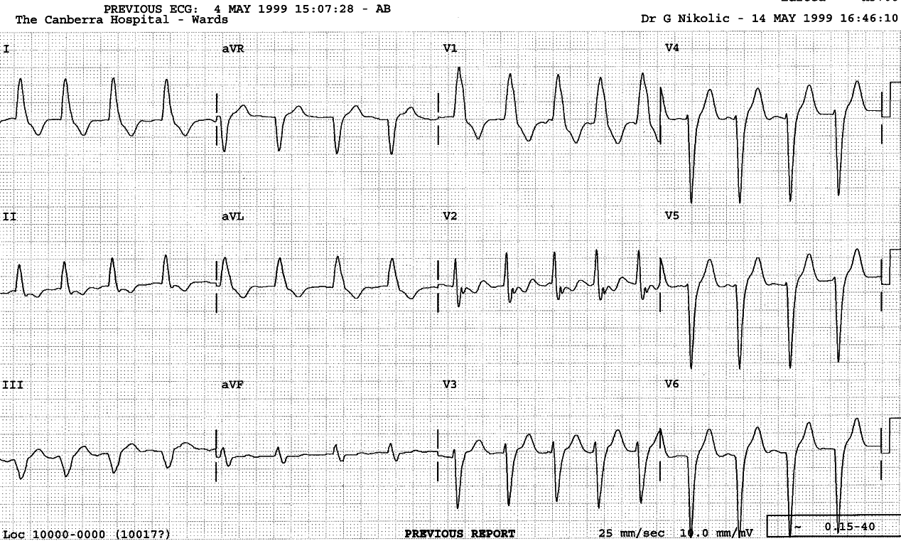 64 year old man with Poland syndrome