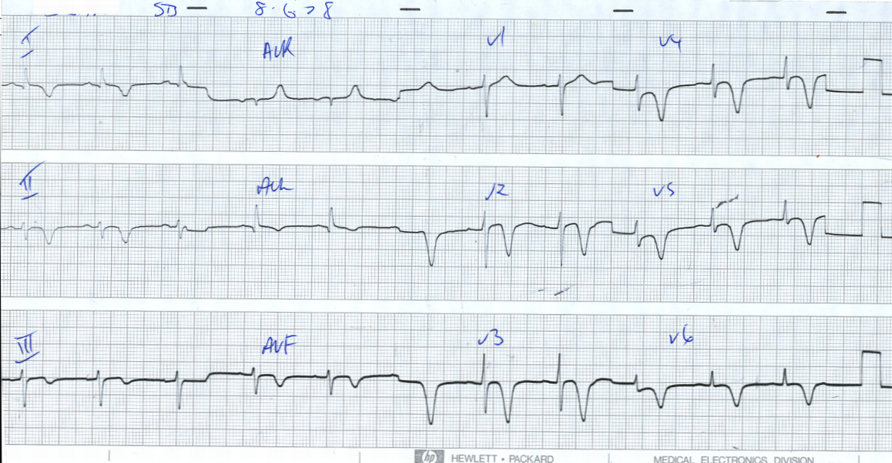 Deep, symmetrical, durable T inversion three weeks later. âSubendocardialâ infarct of yore.