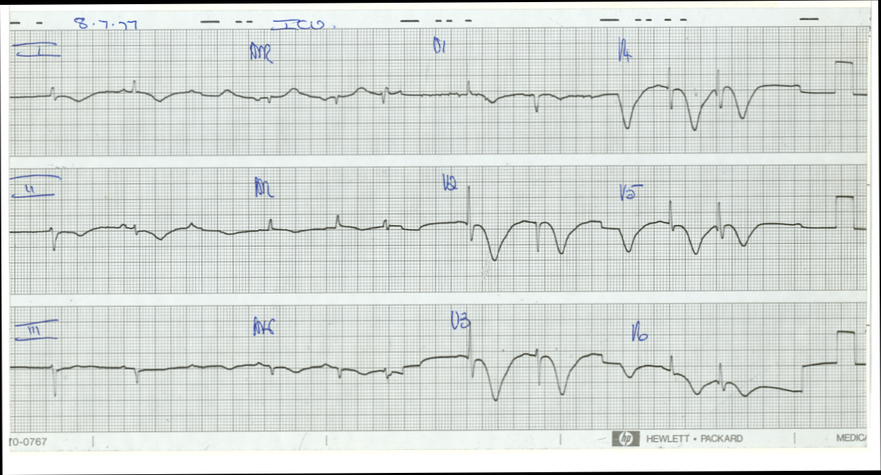 79 year old man after peripheral vascular repair under GA over 7 hours