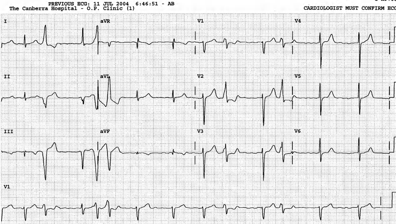 Still slower on more sotalol. The anomalous beats mime parasystole. 