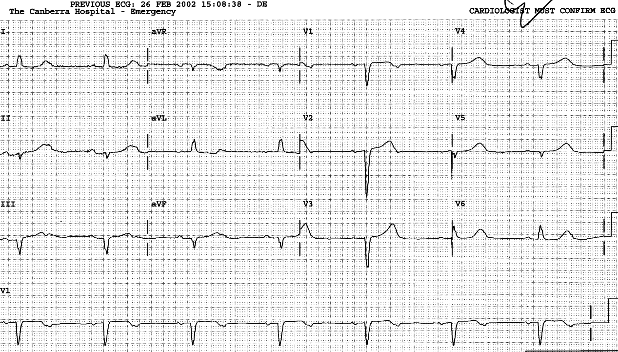 Sinus rhythm with advanced (âhigh-gradeâ) 2o AVB. 