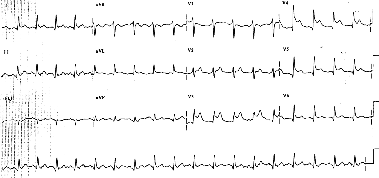 62 year old man two days after a push-bike accident, in CCU because of persistent chest pain and this ECG.