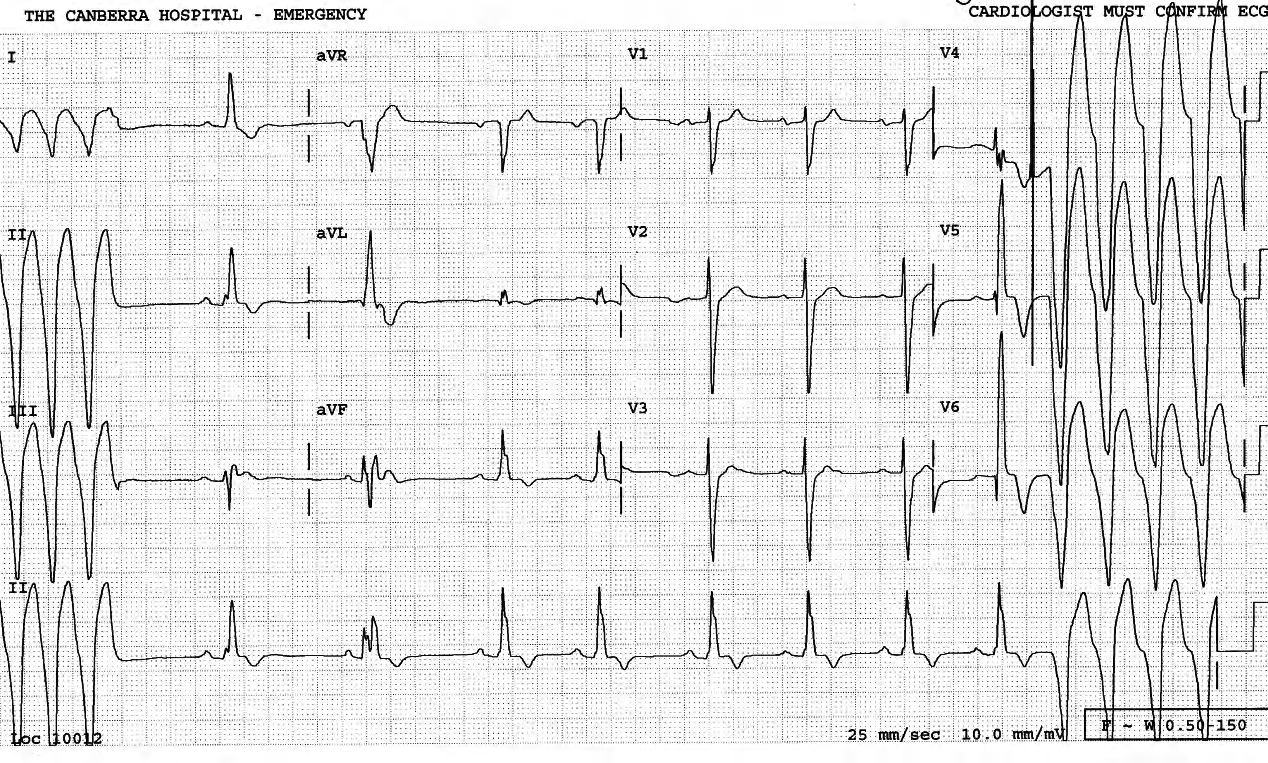 70 year old lady with chronic ischaemic heart disease and recent episodes of chest pain and dizziness. 