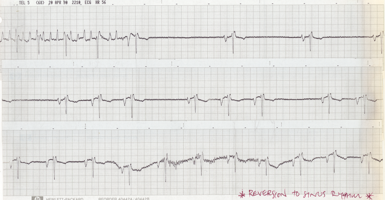 Lead V1. Sleeping 50 year old man on quinidine and digoxin, scheduled for DC cardioversion in the morning. 