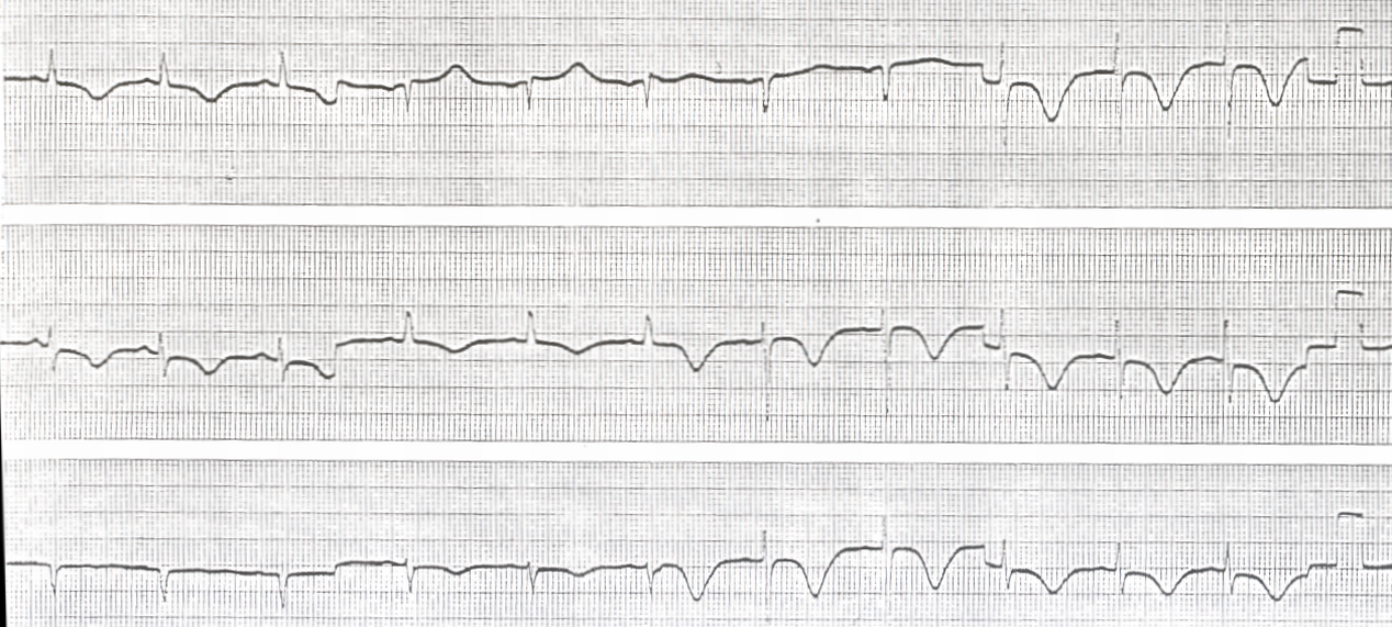 63 year old lady post-cholecystectomy. Her records showed two more instances of post- anÃ¦sthetic T wave inversion.