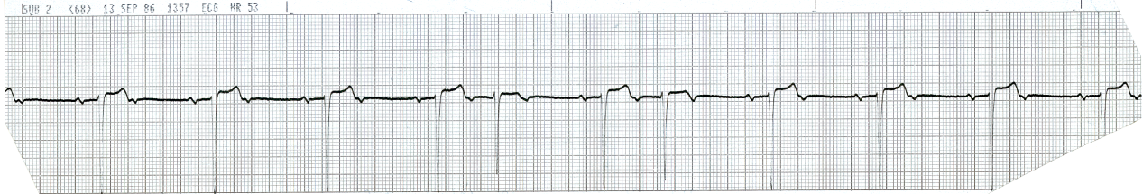 Asymptomatic 63 year old man on Day 3 of acute inferolateral     infarction. What is the long and the short of his rhythm? 