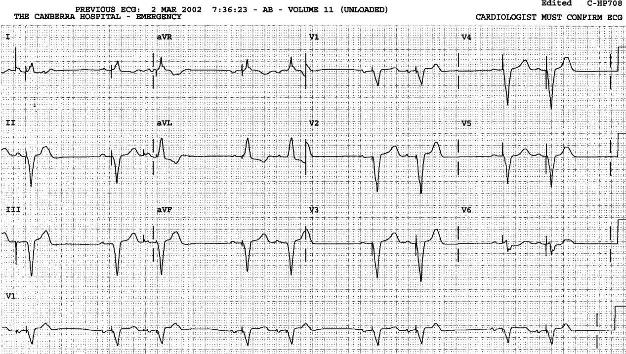 Sinus rhythm with 2:1 AVB and LBBB. The QT/T appearance probably reflects a âcerebralâ event, probably a Sokes-Adams attack rather than the reported âgrayoutâ. 