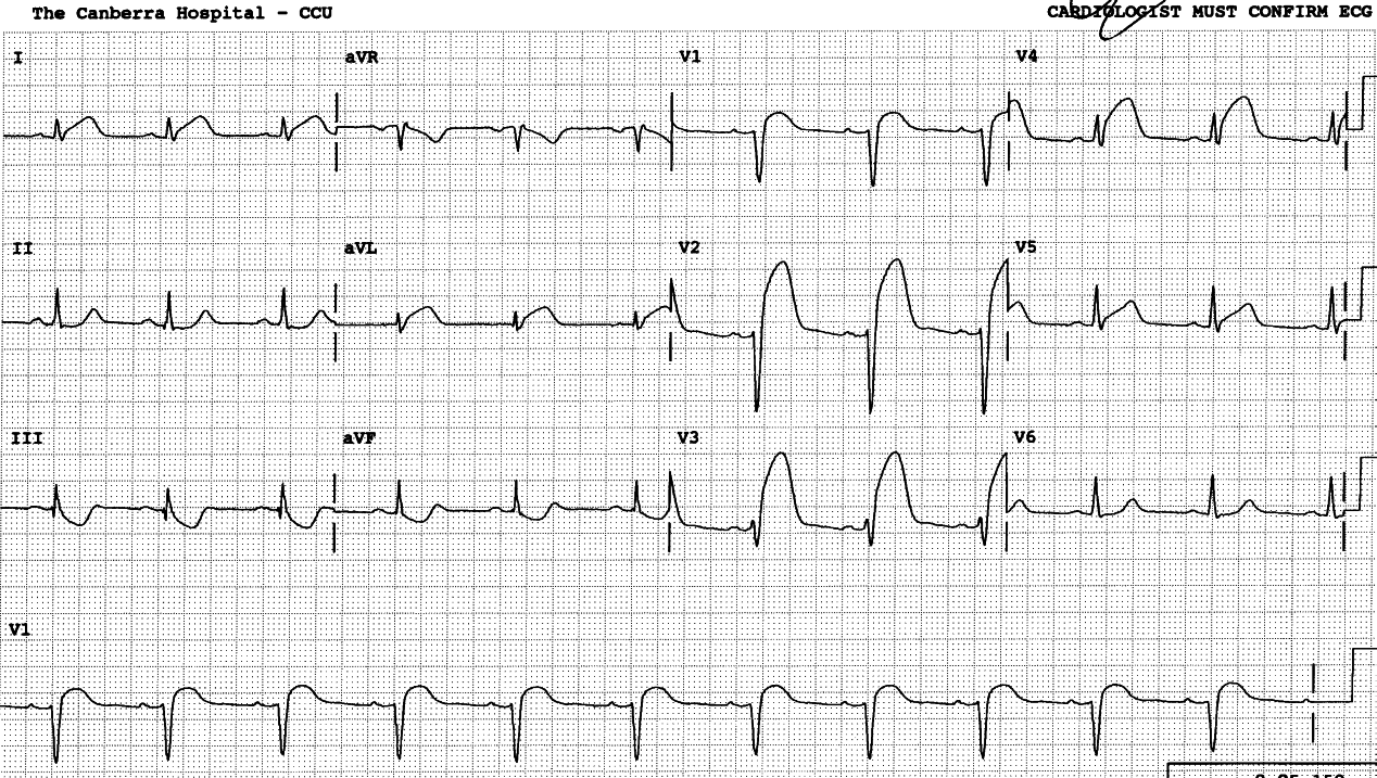 35 year old man with chest pain and no coronary ârisk factorsâ.