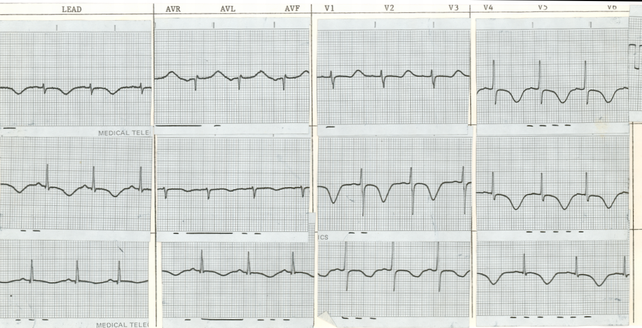 30 year old lady who suffered cardiac arrest after adrenaline injection for a minor procedure