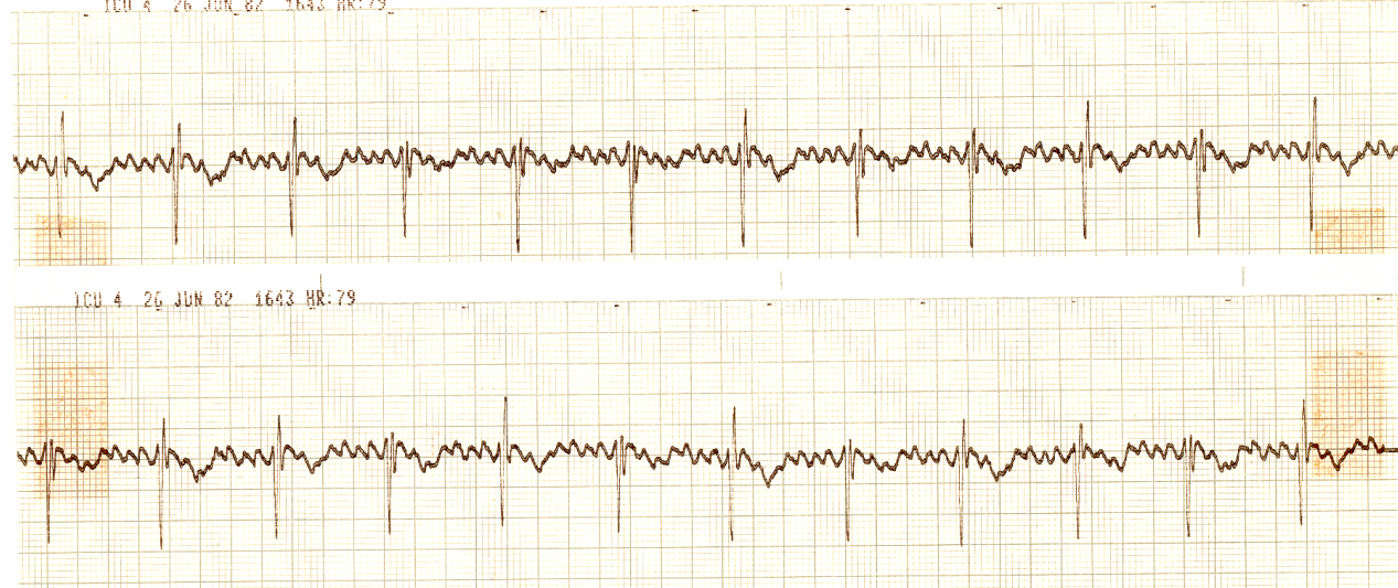 51 year old hypertensive female treated with digoxin     and verapamil for postoperative atrial fibrillation. When the surgeon     asked his Registrar whether the therapy was successful, the latter said:     âYes and noâ. This was true, but enraged the surgeon, and further     explanation became necessary. 