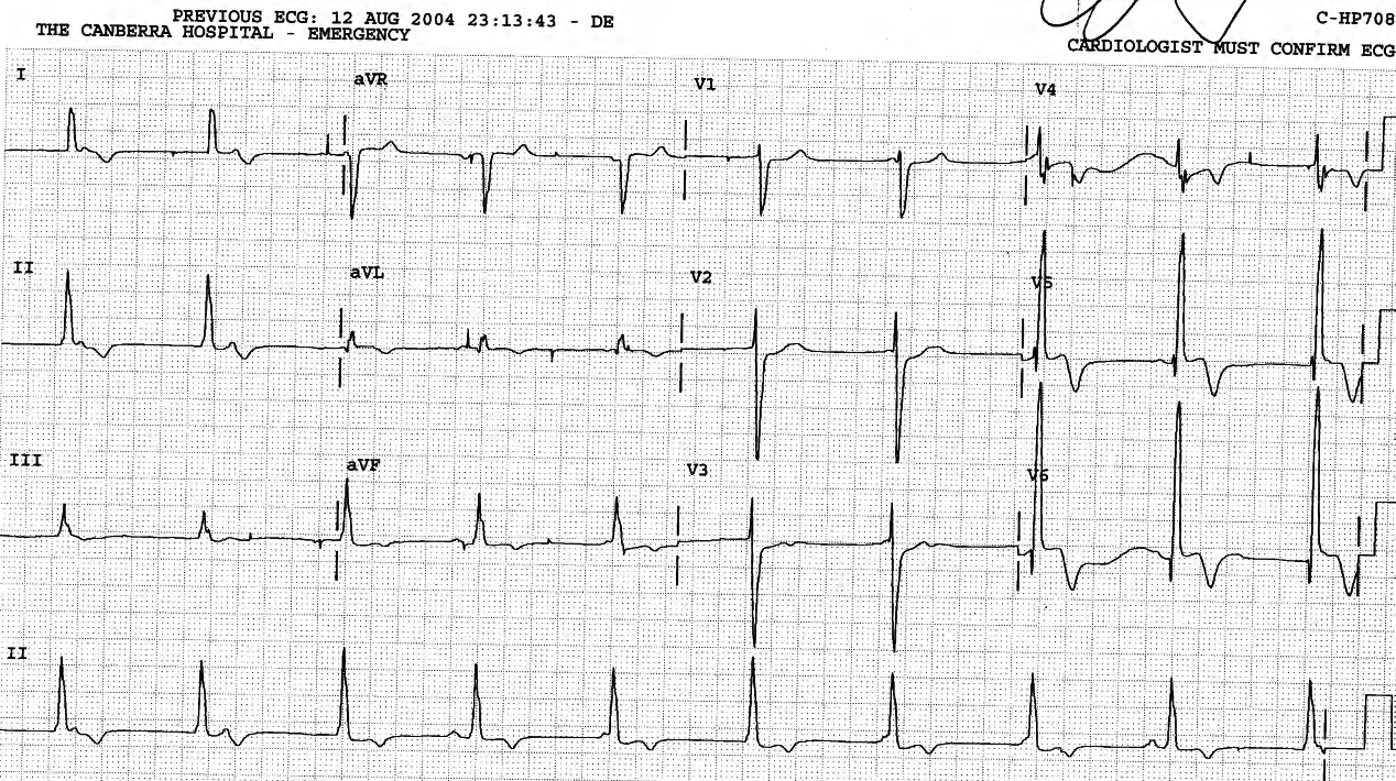 Real captures are early, often fought over a long PR interval. The two in this trace are pseuds. Compare them to those in the previous trace. The main diagnostic point here is that the junctional rhythm remains regular throughout the AV dissociation. 