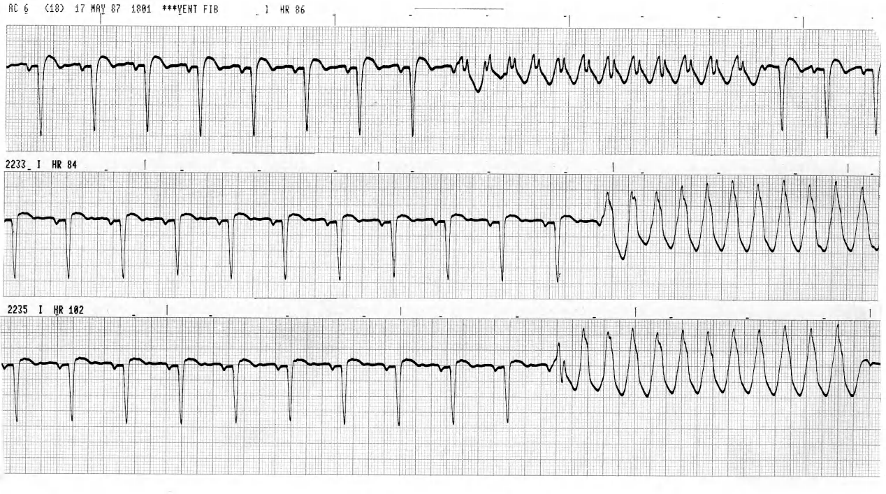 Recurrent broad complex tachycardia in a 60 year old man with ischÃ¦mic cardiomyopathy, hypoxic prior to intubation. 