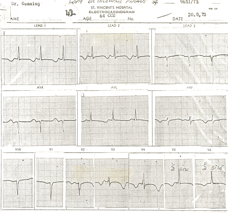 64 year old lady with essential hypertension, cardioverted from atrial flutter with quinidine